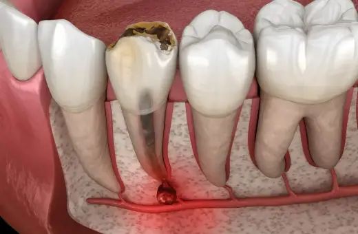 Zepsuty ząb z zapaleniem wierzchołka korzenia. To pokazuje, dlaczego endodoncja co to jest, jest ważna dla ratowania zębów.