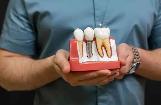 Model szczęki pokazuje, jak działa implant zęba, zastępując korzeń naturalnego zęba.