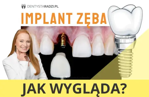 Implant zęba przed i po: widok na implant w dziąśle, protezę zębową i uśmiechniętą dentystkę.