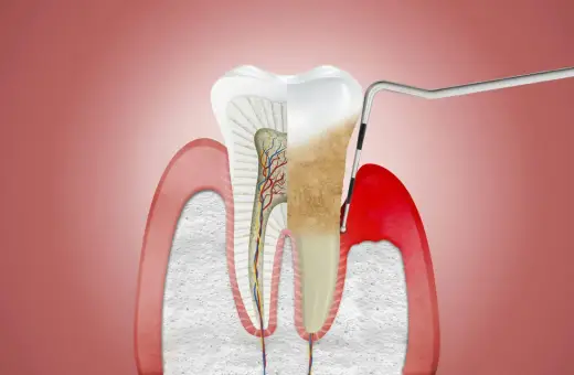 Przekrój zęba z widocznymi naczyniami krwionośnymi i nerwami. Narzędzie dentystyczne usuwa kamień nazębny, odsłaniając zdrowe przyzębie.