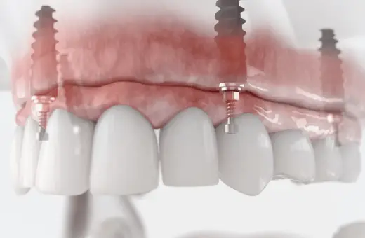 Model szczęki z implantami. Widoczne podniesienie dna zatoki szczękowej, przygotowanie do wszczepienia implantów.