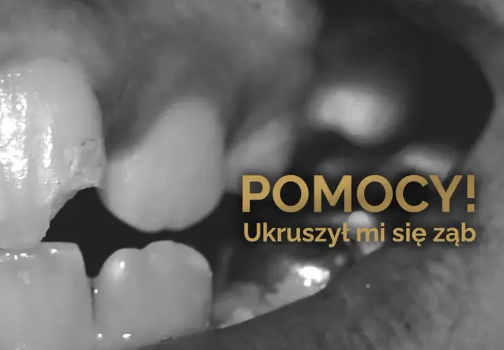 Zbliżenie na ukruszony ząb w jamie ustnej. Napis "POMOCY! Ukruszył mi się ząb" sugeruje pilną potrzebę interwencji dentystycznej.