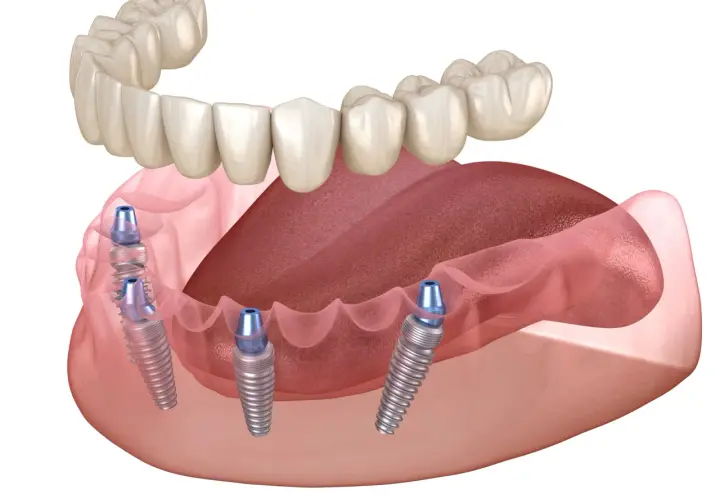 Górna proteza zębowa opiera się na implantach wszczepionych w szczękę. Widok z boku ukazuje cztery implanty.