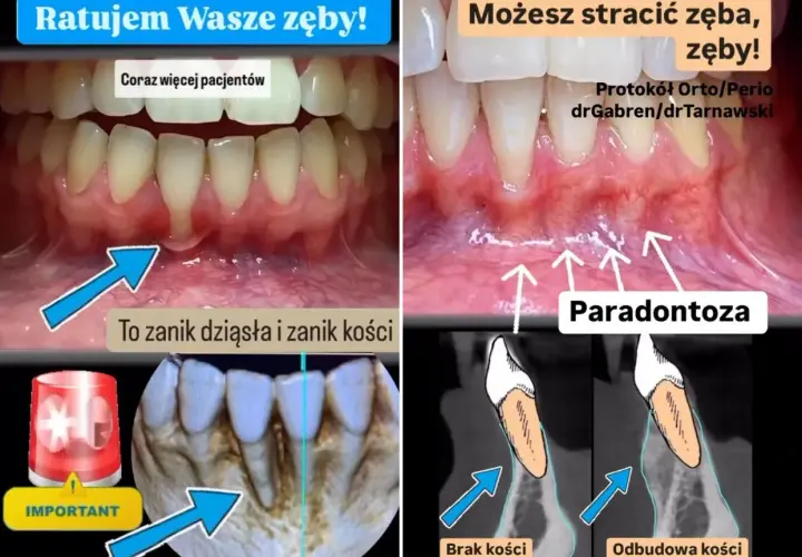 Przed i po leczeniu paradontozy: zanik dziąseł i kości, a następnie odbudowa. Ratujemy zęby!