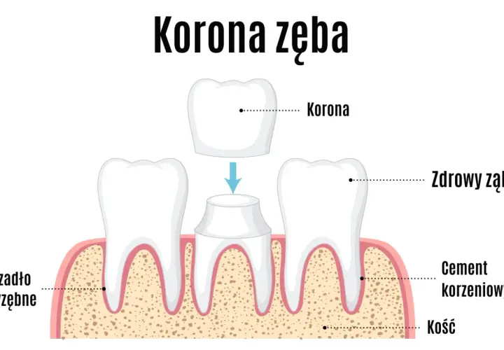 Ilustracja pokazuje proces zakładania korony na ząb. Zastanawiasz się, ile kosztuje koronka na jednego zęba?