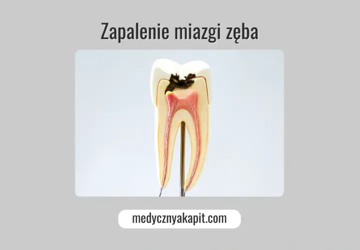 Model zęba ukazujący próchnicę i zapalenie miazgi. Widoczne są uszkodzone tkanki i czerwona miazga.