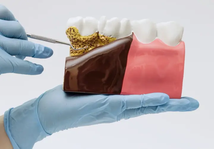 Model szczęki z widocznym spuchniętym dziąsłem i kamieniem nazębnym, badany narzędziem dentystycznym.