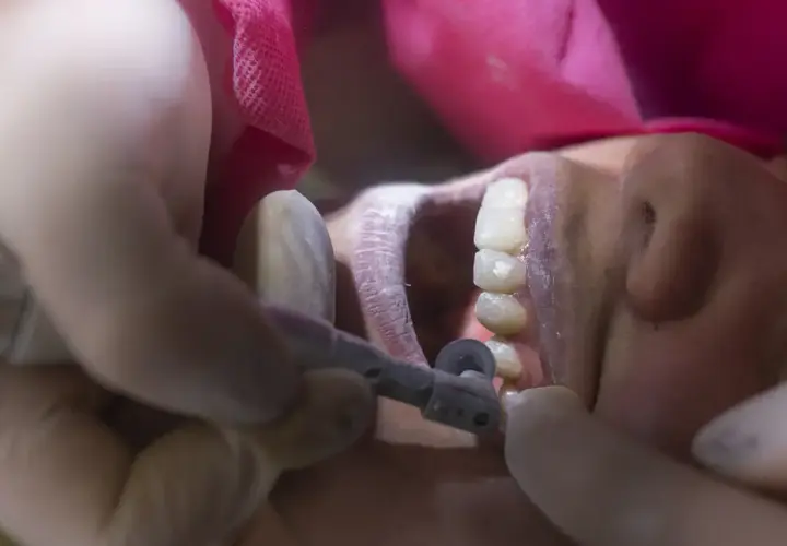 Dentysta wygładza ostry brzeg kości po usunięciu zęba, używając małego wiertła.