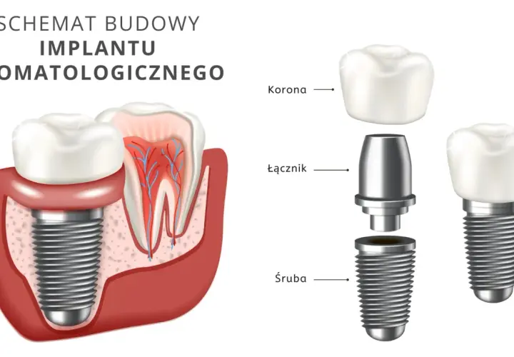Schemat budowy implantu stomatologicznego. Dowiedz się, ile kosztuje implant zęba 6 i jak jest zbudowany: śruba, łącznik i korona.