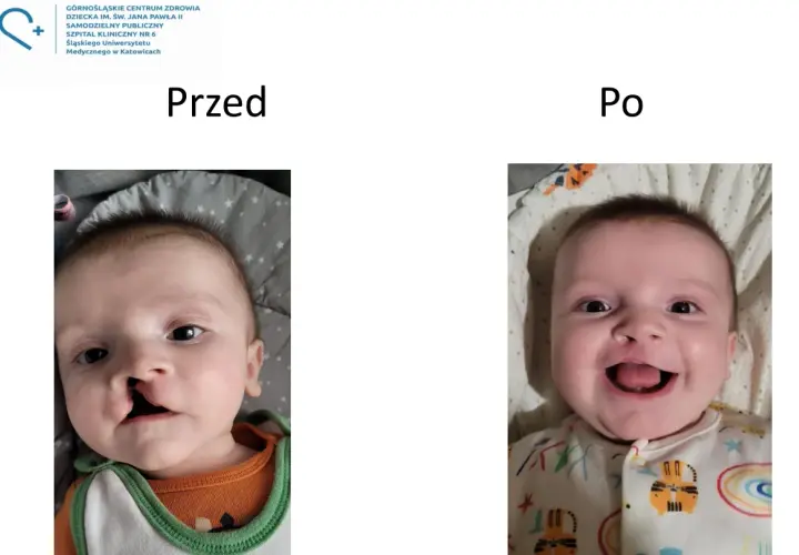 Uśmiechnięty chłopiec po korekcie zajęczej wargi. Po lewej widać szew, po prawej uśmiech.