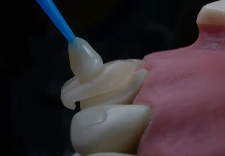 Precyzyjna odbudowa zęba na włóknie szklanym. Dentysta aplikuje materiał na model.