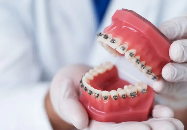 Dłonie w rękawiczkach trzymają model szczęki z aparatem ortodontycznym. To praca technika dentystycznego.