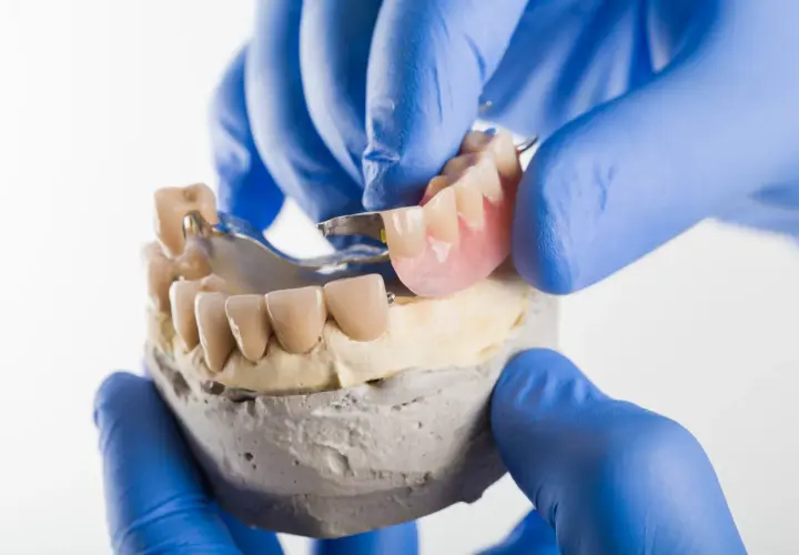 Dentyści prezentują protezę szkieletową na zatrzaskach, dopasowując ją do modelu szczęki.