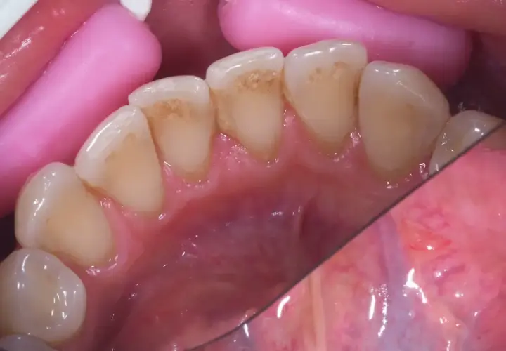 Widoczne przebarwienia i czarny osad na zębach, widoczne są też różowe retraktory dentystyczne.