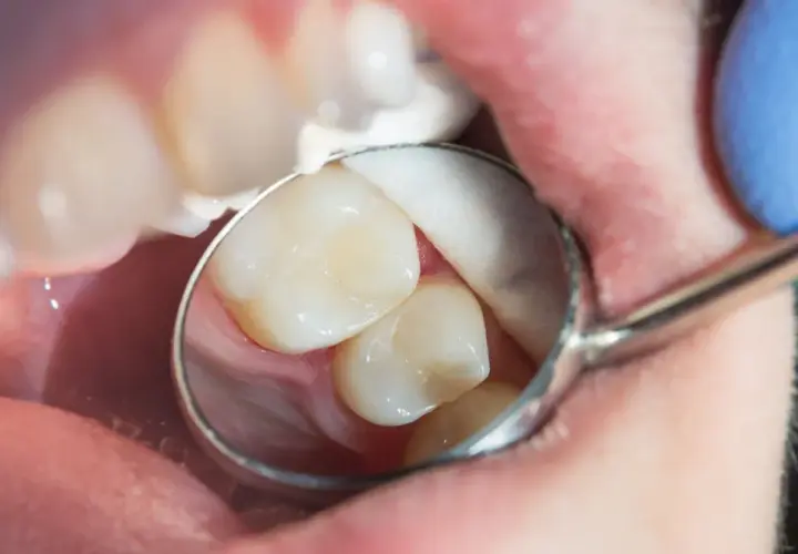 Dentysta bada zęby, szukając próchnicy ukrytej. Widoczne są zęby, lusterko dentystyczne i wata.