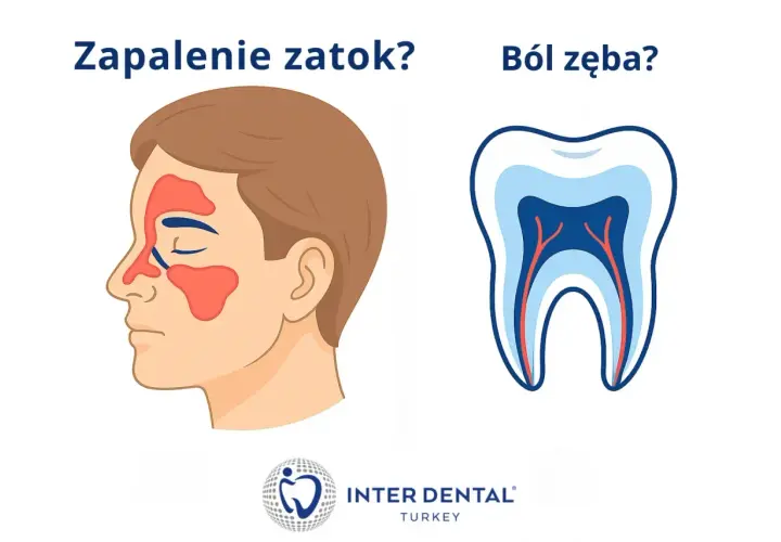 Ilustracja porównuje objawy zapalenia zatok szczękowych z bólem zęba.