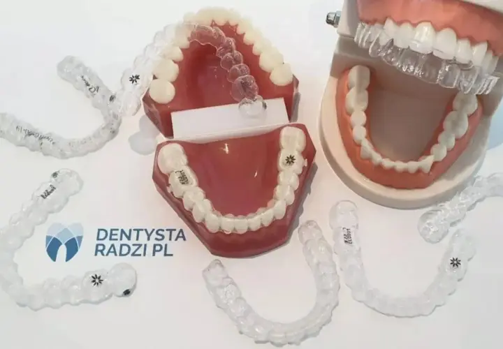 Nakładki czy aparat? Cena, komfort, skuteczność co wybrać?
