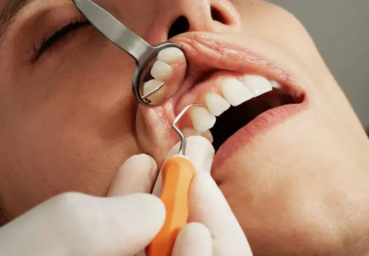 Dentysta usuwa kamień z zębów. Czy usuwanie kamienia boli? Zazwyczaj nie, ale zależy od wrażliwości pacjenta.