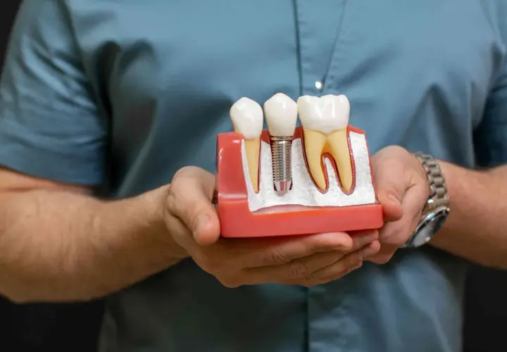 Model szczęki pokazuje, jak działa implant zęba, zastępując korzeń naturalnego zęba.