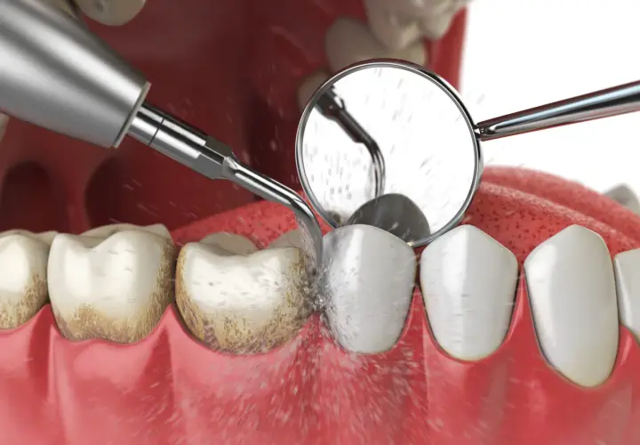 Zabieg odkamieniania zębów: ultradźwiękowe usuwanie kamienia nazębnego z widocznym strumieniem wody i odbiciem w lusterku dentystycznym.