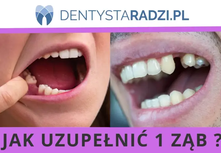 Dwa zbliżenia ust pokazujące braki w uzębieniu. Po lewej stronie widać palec wskazujący na brakujący ząb. Po prawej stronie widoczny jest brakujący ząb. Temat: hipodoncja.