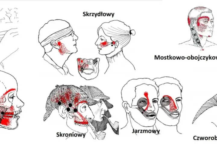 Ilustracje pokazują punkty bólu związane z różnymi typami bólu głowy, które mogą być mylone z objawami nowotworu stawu skroniowo-żuchwowego.