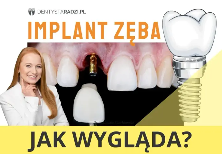 Implant zęba przed i po: widok na implant w dziąśle, protezę zębową i uśmiechniętą dentystkę.