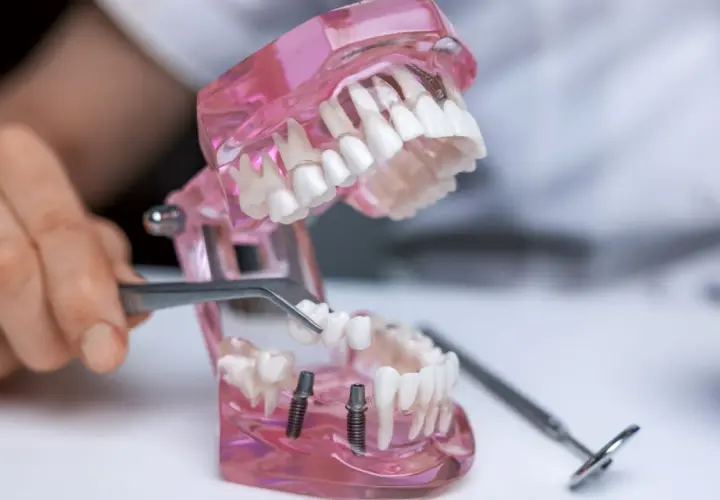 Model szczęki pokazuje wstawienie zęba. Pęseta trzyma protezę, która ma być umieszczona na implantach.