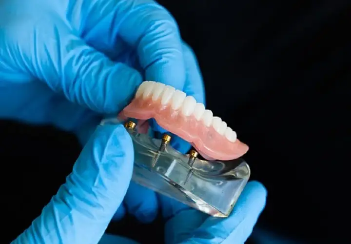 Ręce w niebieskich rękawiczkach trzymają model szczęki z implantami i cienkie protezy zębowe.