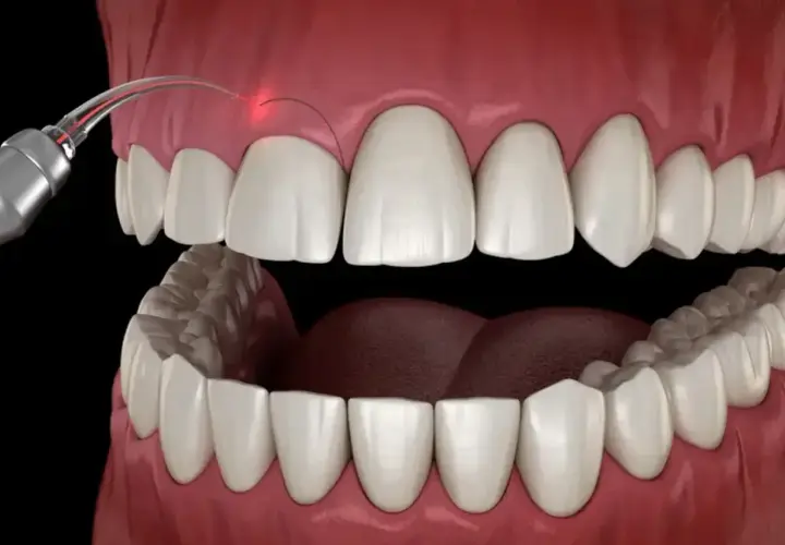 Zabieg gingiwektomii laserem. Precyzyjne modelowanie dziąseł dla pięknego uśmiechu.