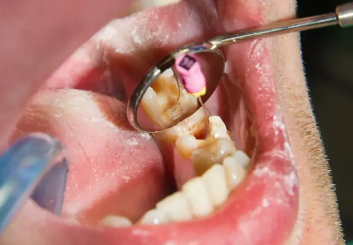 Zgorzel zęba w odbiciu lusterka dentystycznego. Widoczny jest ząb z ubytkiem i narzędzie stomatologiczne.