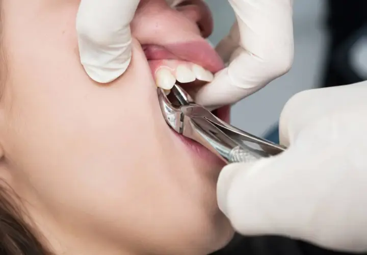 Dentysta wyrywa ząb kleszczami. Czy wyrywanie zęba boli? To zależy od znieczulenia i indywidualnego progu bólu.