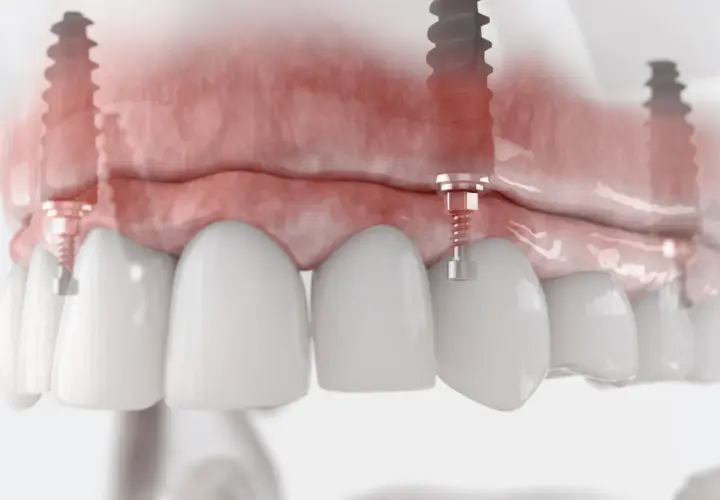 Model szczęki z implantami. Widoczne podniesienie dna zatoki szczękowej, przygotowanie do wszczepienia implantów.