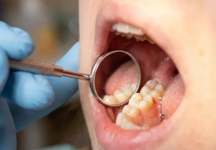 Dentysta w niebieskiej rękawiczce bada zęby lusterkiem. Widać na nich osad, który może być początkiem płytki nazębnej.