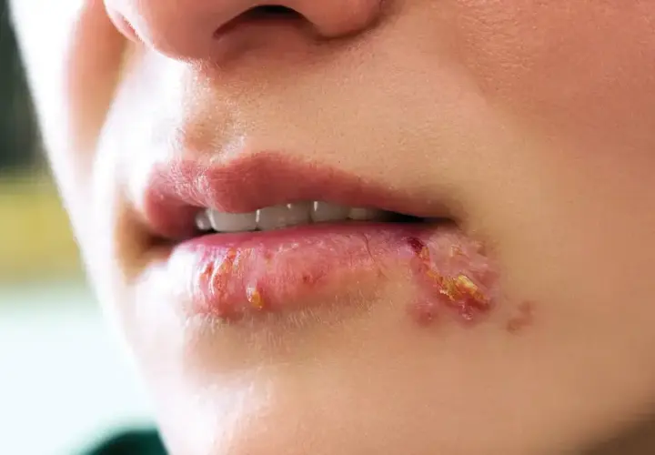 Usta z widoczną opryszczką. Czy z opryszczką można iść do dentysty? Warto skonsultować się z lekarzem.