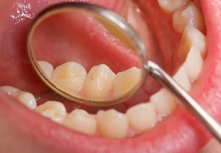 Widok jamy ustnej z lusterkiem dentystycznym, uwidaczniającym białe plamy na zębach.