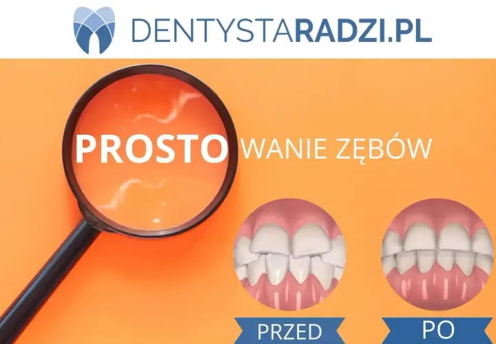 Przed i po: proste zęby dzięki licówkom. Zobacz, jak licówki na krzywe zęby zmieniają uśmiech.