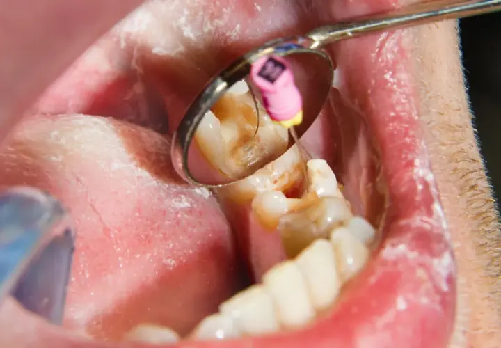 Lekarz stomatolog bada ząb, który daje pulsujący ból zęba. Widać narzędzia dentystyczne i wnętrze jamy ustnej.