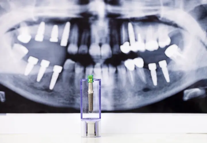 Zęby na zdjęciu RTG i implant w etui. Może to symbolizować odrzucenie implantu zęba lub jego przygotowanie.