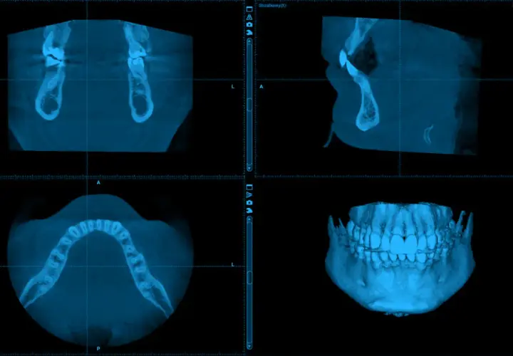 Trzy widoki badania CBCT szczęki i żuchwy, w tym widok 3D.