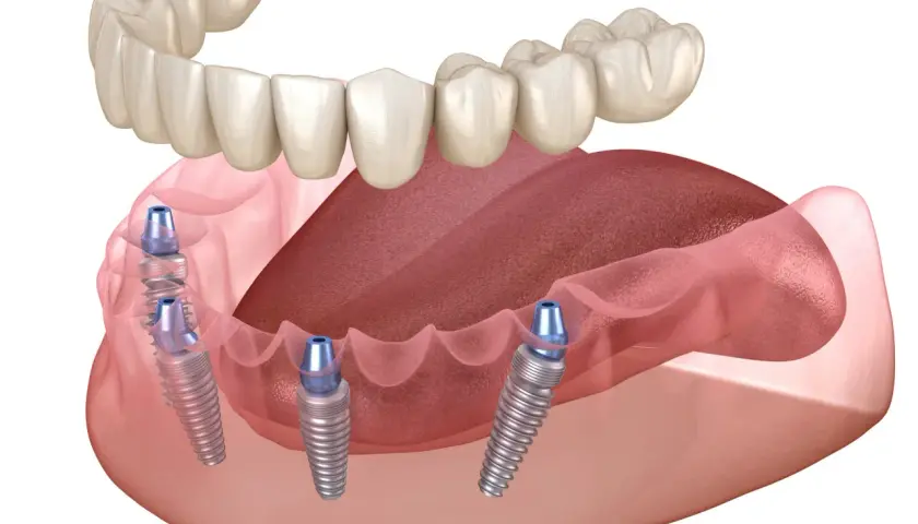 Górna proteza zębowa opiera się na implantach wszczepionych w szczękę. Widok z boku ukazuje cztery implanty.