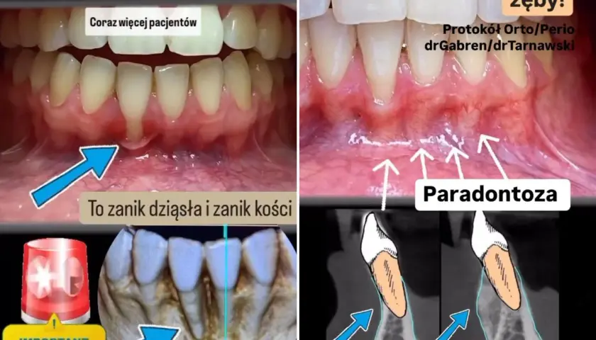 Przed i po leczeniu paradontozy: zanik dziąseł i kości, a następnie odbudowa. Ratujemy zęby!
