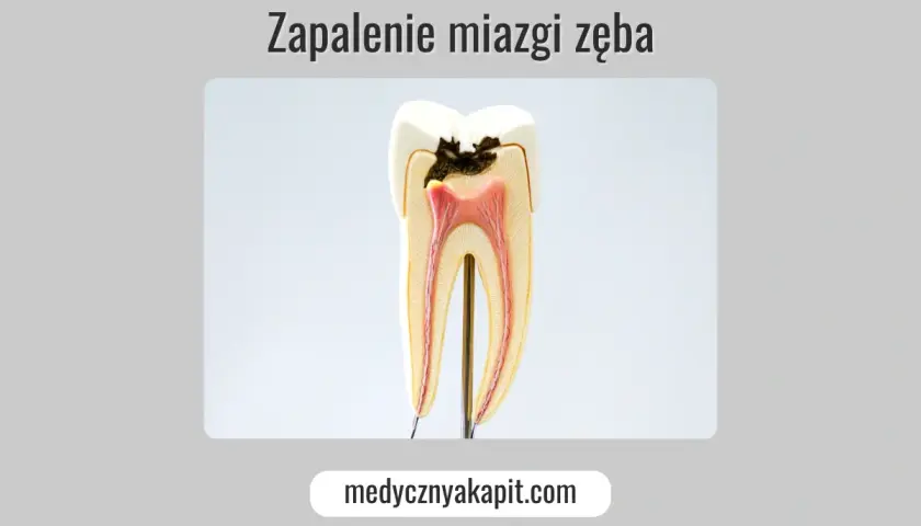 Model zęba ukazujący próchnicę i zapalenie miazgi. Widoczne są uszkodzone tkanki i czerwona miazga.