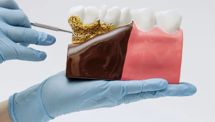 Model szczęki z widocznym spuchniętym dziąsłem i kamieniem nazębnym, badany narzędziem dentystycznym.