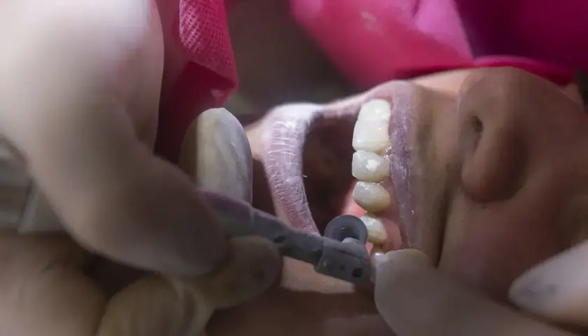 Dentysta wygładza ostry brzeg kości po usunięciu zęba, używając małego wiertła.