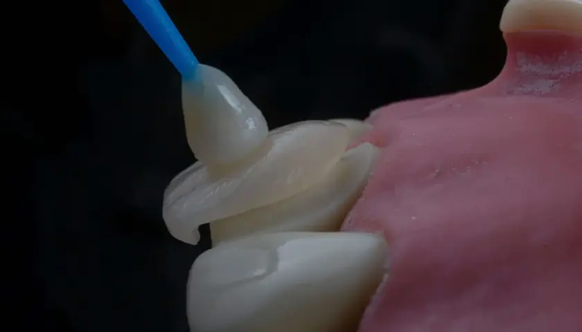 Precyzyjna odbudowa zęba na włóknie szklanym. Dentysta aplikuje materiał na model.