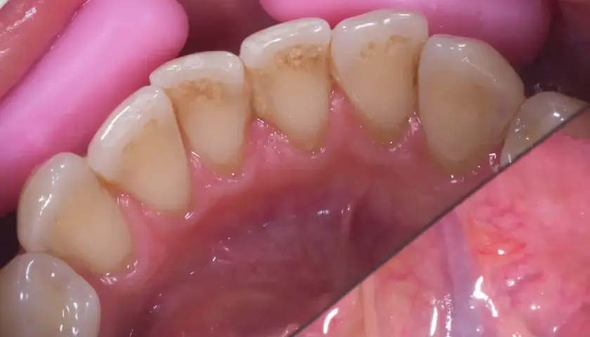 Widoczne przebarwienia i czarny osad na zębach, widoczne są też różowe retraktory dentystyczne.