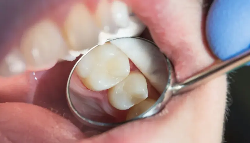Dentysta bada zęby, szukając próchnicy ukrytej. Widoczne są zęby, lusterko dentystyczne i wata.