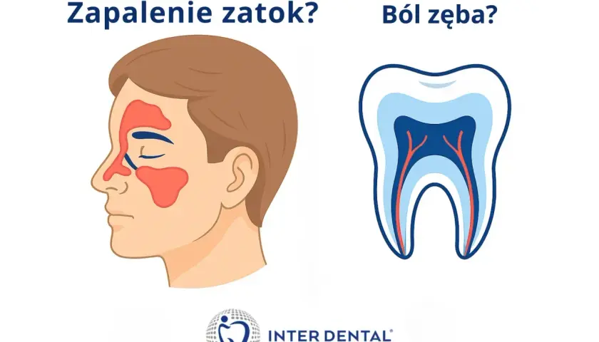 Ilustracja porównuje objawy zapalenia zatok szczękowych z bólem zęba.
