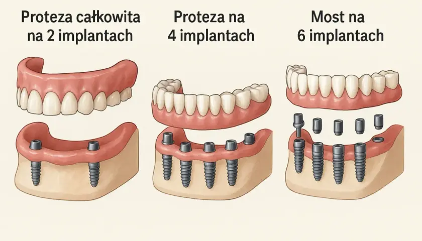 Nowoczesne protezy zębowe całkowite cena zależy od liczby implantów: na 2, 4 lub 6.